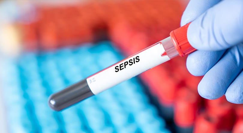 Sepsis Sepsis